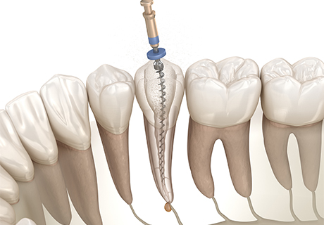 進行した虫歯でも抜歯せずに治療する「根管治療」